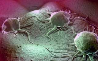 Почему появляется опухоль в паху у мужчин?