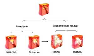 С чем может быть связано образование прыщей на члене?