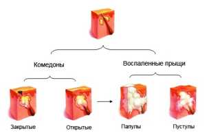 С чем может быть связано образование прыщей на члене?