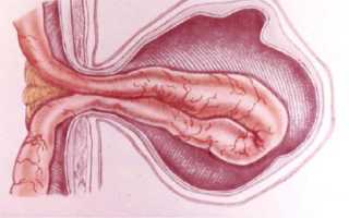Паховая грыжа у мужчин: симптомы и лечение