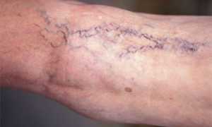 Проявление и лечение варикозного расширения вен малого таза у мужчин