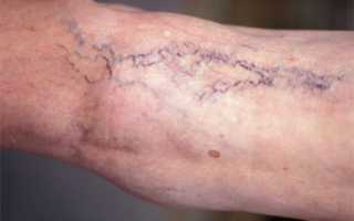 Проявление и лечение варикозного расширения вен малого таза у мужчин