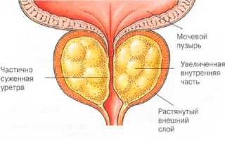 Как правильно лечить острый простатит?