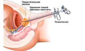 Когда мужчинам рекомендована операция ТУРП?