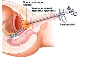 Когда мужчинам рекомендована операция ТУРП?