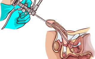 Уретроскопия: как она проводится у мужчин