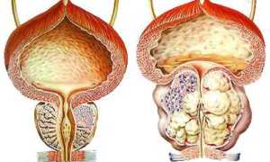 Рак 3 степени простаты: прогноз и лечение