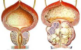 Рак 3 степени простаты: прогноз и лечение