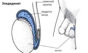 По какой причине возникает острый эпидидимит