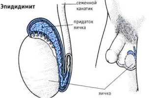 По какой причине возникает острый эпидидимит