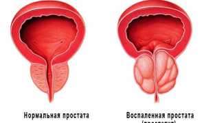 Симптомы и лечение простатита