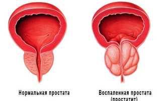 Симптомы и лечение простатита