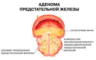 Как лечить камни в предстательной железе?