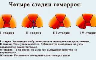 Причины появления геморроя у мужчин