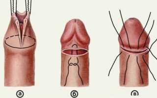 Что делать, если крайняя плоть срослась с головкой пениса?