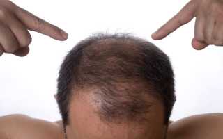 Как остановить выпадение волос: полезные советы