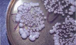 Как выглядит молочница у мужчин и нужно ли ее лечить?