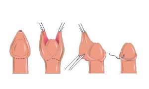 Что такое обрезание и кому показана такая процедура?