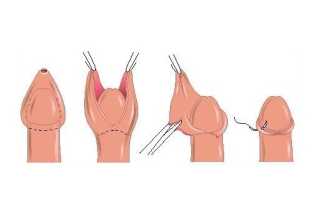 Что такое обрезание и кому показана такая процедура?