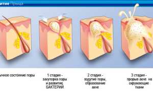 Причины прыщей на теле и грудине у мужчин