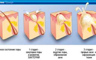Причины прыщей на теле и грудине у мужчин