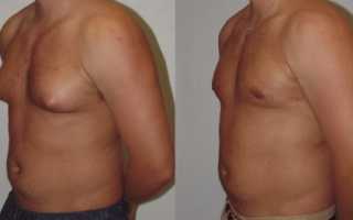 Основные способы лечения при гинекомастии