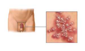 Диагностика и лечение герпеса у мужчин