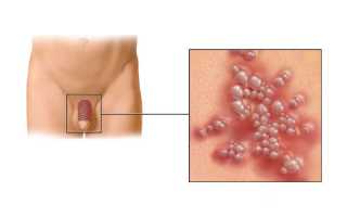 Диагностика и лечение герпеса у мужчин
