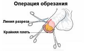 В каких случаях назначается операция обрезания?