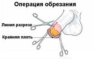 В каких случаях назначается операция обрезания?