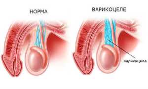 Особенности лечения варикоцеле без операции