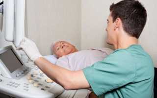 Аденома простаты: обструктивные и ирритативные симптомы