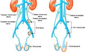 Варикоцеле: как правильно проводить лечение