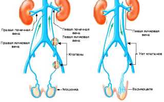 Варикоцеле: как правильно проводить лечение