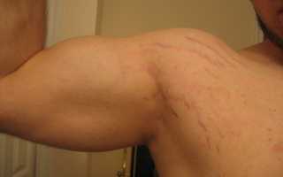 Как устранить растяжки на руках у мужчин