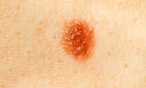 Опасна ли родинка на члене и как от неё избавиться?