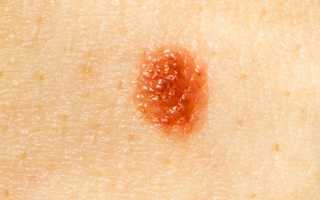 Опасна ли родинка на члене и как от неё избавиться?