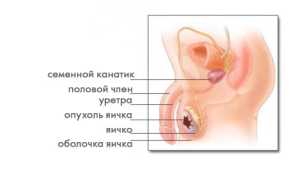 Что такое олиготератозооспермия?