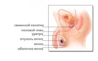 Что такое олиготератозооспермия?