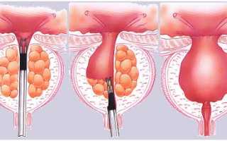 Операция по выполнению лазерной вапоризации аденомы простаты