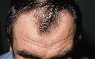 Выпадают волосы у мужчин — что делать?