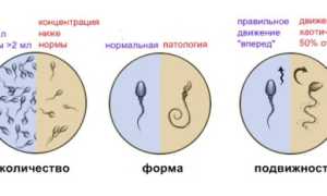 Почему бывают сгустки в сперме у мужчин