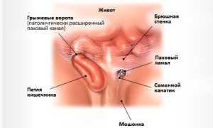 Особенности реабилитации после операции по удалению паховой грыжи у мужчин