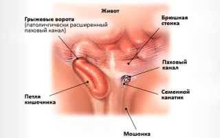 Особенности реабилитации после операции по удалению паховой грыжи у мужчин