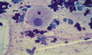 Гонококк как разновидность диплококков у мужчин