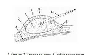 Опасны ли жировики на члене?