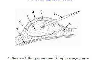 Опасны ли жировики на члене?
