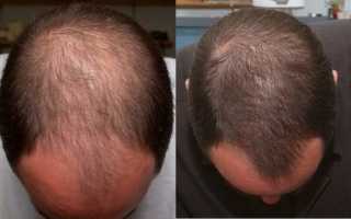 Средство от облысения для мужчин: отзывы о препаратах и методах