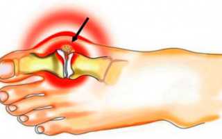 Признаки и симптомы подагры у мужчин