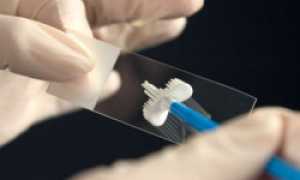 Лейкоциты в мазке и моче у мужчин